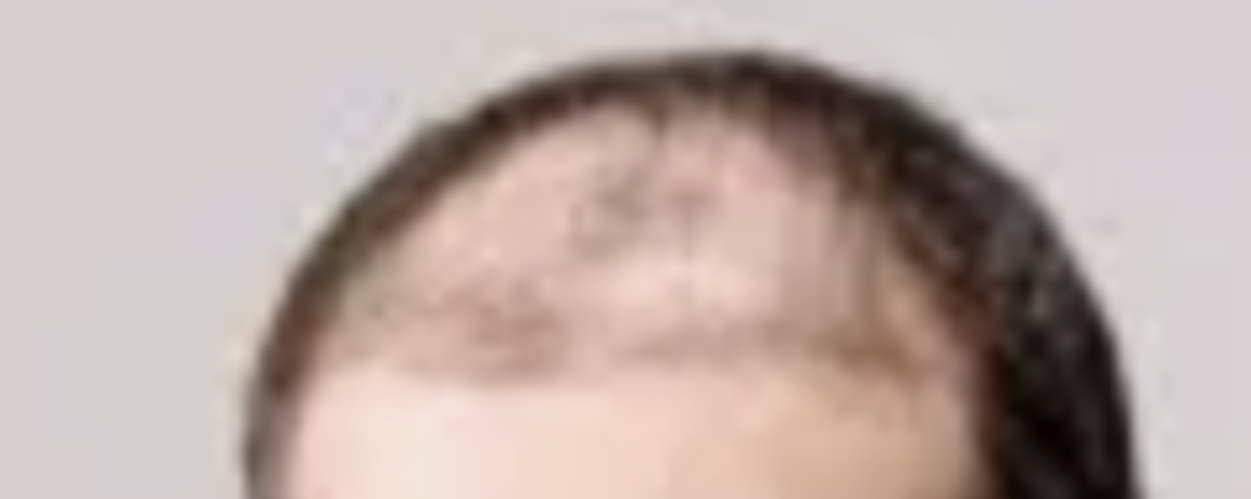 OpenAI Top Jew Fired, Israeli Jew with Botched Hair Implants Now Presumed in Charge